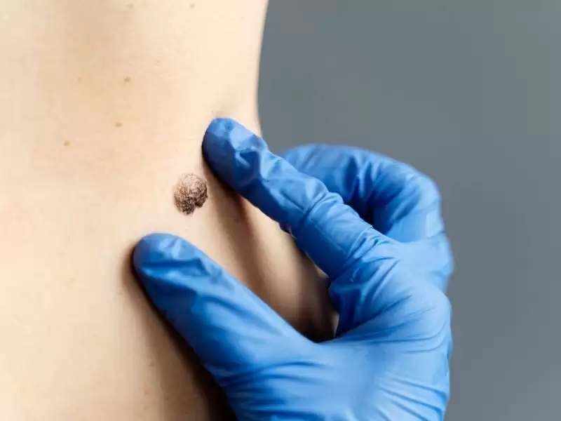 Genital Siğiller