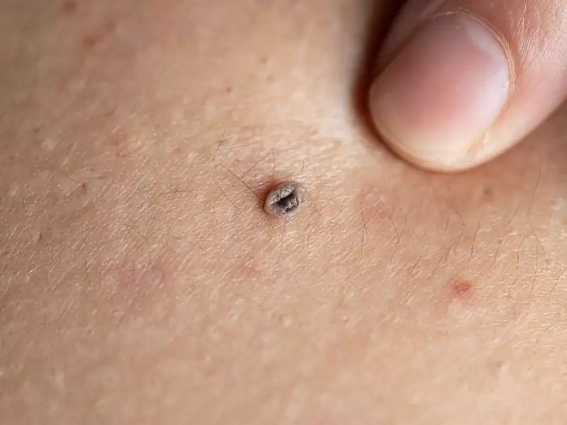 Vajina Siğiline Karşı Alınabilecek Önlemler