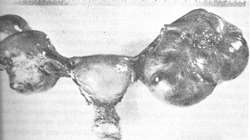 cift-tarafli-adenomyozis