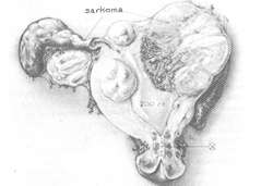dejenere-submukoz-sarkom