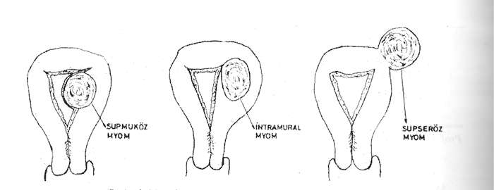 myomun-rahim-tabakalarina-gore-lokalizasyonu